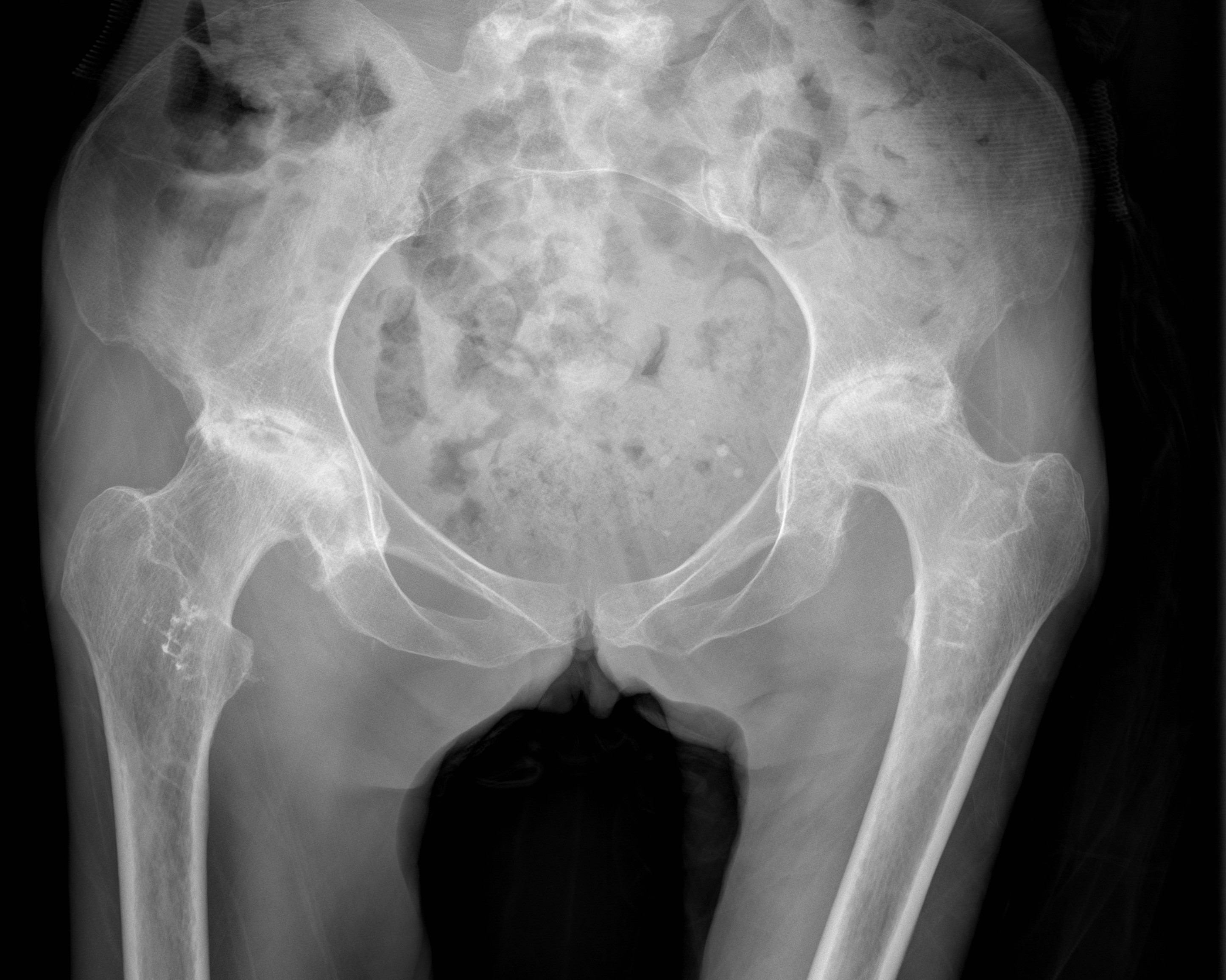 Bilateral Hip AVN Xray